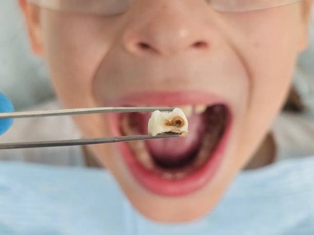Best Same-Day Emergency Dental Services in Oak Grove, LA
